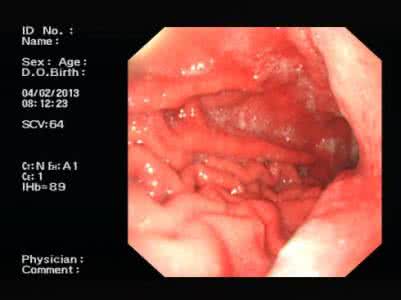 门静脉高压性胃病 门脉高压性胃病的治疗