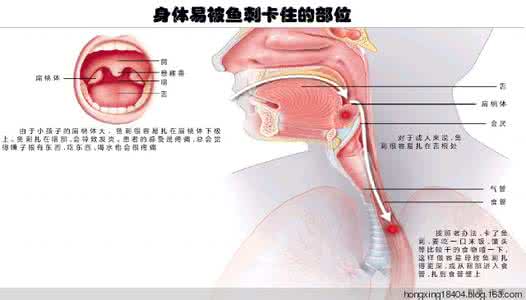 喉咙有鱼刺卡住小巧门 鱼刺卡喉 鱼刺卡喉咙的时候这样处理