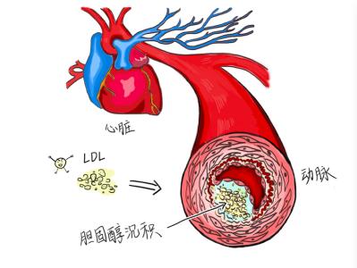 印戎细胞癌 国宝秘方：直肠印戎细胞癌恶性腹水一月即可痊愈出院旅游