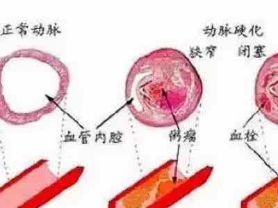 胆固醇与心脑血管疾病 如何控制好胆固醇 给血管减龄防“生锈”