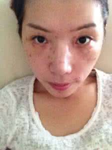 去雀斑的最好医院 去雀斑的医院 去雀斑价格