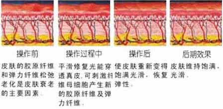 彩光嫩肤祛斑多少钱 彩光嫩肤需要多少钱 彩光嫩肤祛斑多少钱