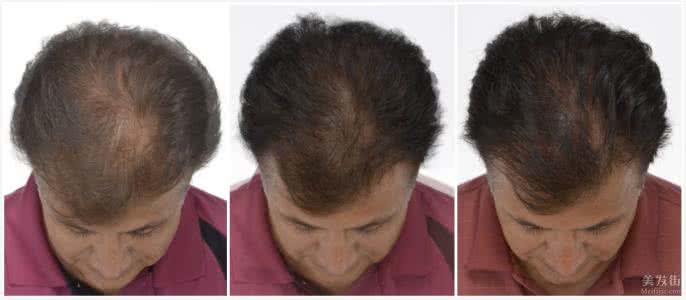 治疗脱发的三种药 治疗脱发集锦
