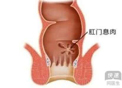 肛门息肉怎么治疗 肛门息肉怎么办 几种方法有效治疗肛门息肉