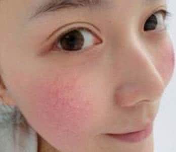 治疗脸部皮肤红血丝 皮肤有红血丝怎么办 如何治疗皮肤有红血丝