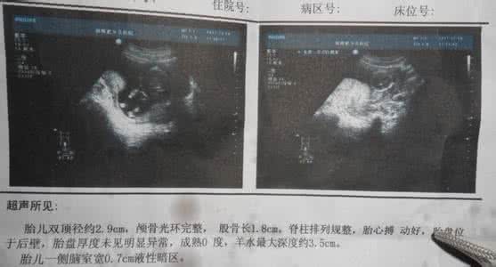 b超多长时间做一次 多长时间做一次b超 孕妇多久做一次b超