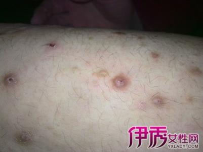 皮肤癌能治愈吗 图文:治愈各种癌症的方法之皮肤癌2方