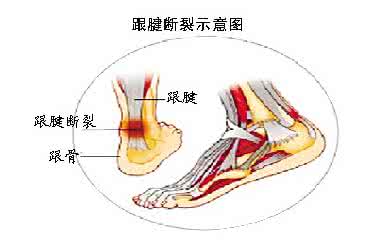 跟腱断裂缝合方法 跟腱断裂 教你跟腱断裂的急救方法