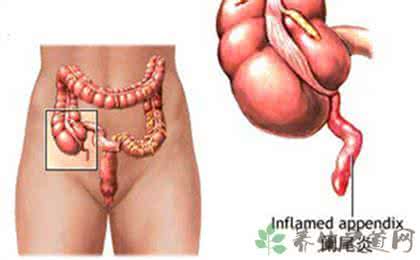 急性阑尾炎手术要多久 急性阑尾炎症状