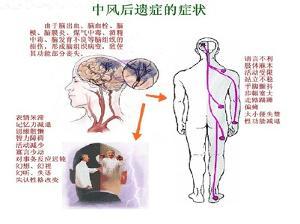 治疗脑血栓最好的医院 什么是脑血栓后遗症 脑血栓后遗症的治疗