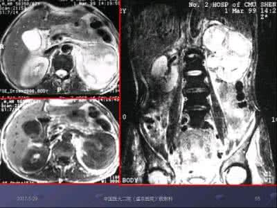 泌尿系统结核严重吗 泌尿系统结核