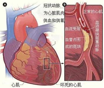 心肌梗死病理图片 专家告诉你“心肌梗死”是什么病? 图