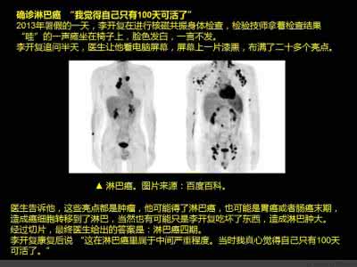 癌症康复 17个月癌症康复