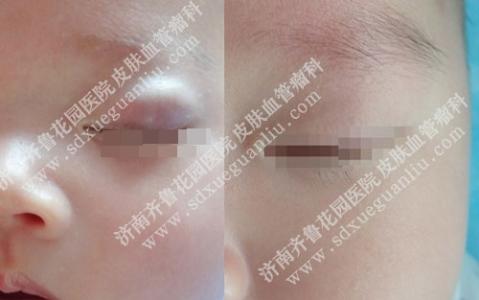 脑海绵状血管瘤治疗 海绵状血管瘤 海绵状血管瘤如何治疗