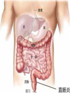 溃疡性直肠炎病因 溃疡性直肠炎病因 女性如何预防直肠炎 了解病因是前提