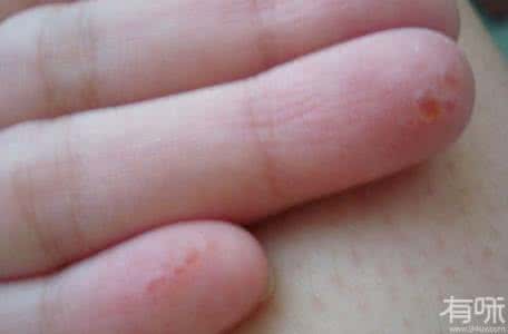 手上起小水泡吃什么药 手上起小水泡吃什么 夏天手上起小水泡怎么办