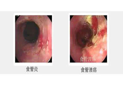 食道炎的早期症状 食道炎的早期症状 如何治疗食道炎