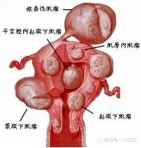 子宫肌瘤有什么后果 子宫肌瘤后果 子宫肌瘤有什么后果?
