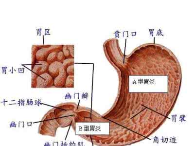 糜烂性胃炎的病因 注意!糜烂性胃炎病因逐个数