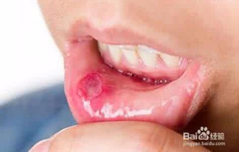 英国口腔溃疡 口腔溃疡怎么办 在英国得了口腔溃疡怎么办？