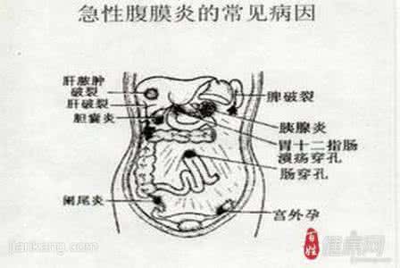 急性阑尾炎中医治疗 急性阑尾炎中医治疗 中医如何辨证治疗急性阑尾炎的？