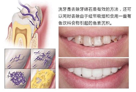 自体脂肪填充鼻基底 自体脂肪填充鼻基底 房有地基，鼻有鼻基底～填脂肪前需谨慎！