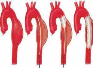 得了动脉瘤怎么办 夹层动脉瘤 主动脉夹层动脉瘤如何治疗