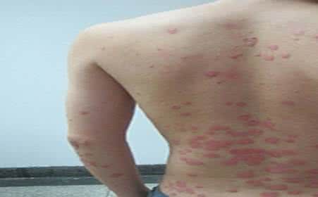 中西医治疗肛裂病 红斑狼疮是什么病 红斑狼疮是什么病 中西医治疗红斑狼疮