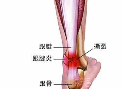 跟腱断裂 青壮年易跟腱断裂 重建恢复难回原状态