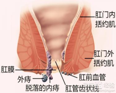 肛门疼是痔疮吗 肛门疼是痔疮的原因吗？