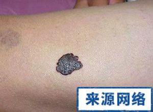 黑痣癌变的征兆图片 黑痣癌变的征兆图片 警惕7种痣会癌变 我们该拿痣怎么办