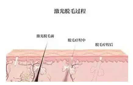 激光脱毛是永久性的吗 激光脱毛是永久性的吗 激光脱毛是永久的吗