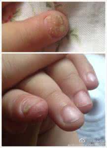 手指缝长湿疹 小孩手指缝湿疹怎么办 儿子被儿童座椅夹伤手指，缝了6针