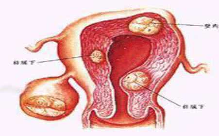 前庭大腺炎怎么治疗 大前庭怎么治疗？