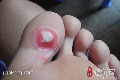 脚上的鸡眼怎么根治 脚上长鸡眼怎么治 脚上鸡眼可以这样处理