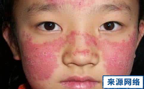 红斑狼疮是什么症状 什么是红斑狼疮 红斑狼疮的症状与治疗