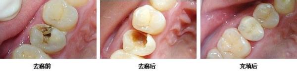 孕妇可以补牙窟窿吗 孕妇可以补牙吗?