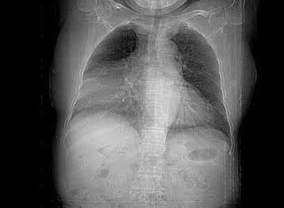 心包囊肿 心包囊肿 心包囊肿有哪些治疗方法