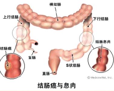 远离自然才能保护自然 这样保护肠道 才能远离结肠癌