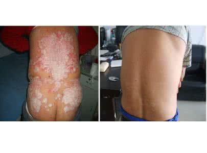 预防是最好的治疗方法 牛皮癣怎么治才好 牛皮癣的治疗与预防