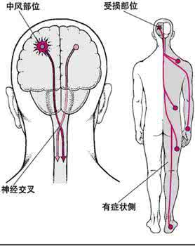 出血性中风 郭氏脑出血方治疗出血性中风