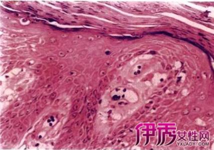龟头上有颗粒咋回事 龟头上有颗粒咋回事 龟头上长肉粒是怎么回事呢？
