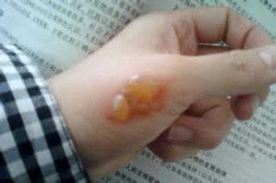 开水烫伤起泡要挑破吗 开水烫伤起泡要挑破吗 烟头烫伤起泡要挑破吗？