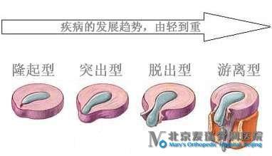 预防腰椎间盘突出 腰椎间盘轻度突出 腰椎间盘突出的治疗方法 腰椎间盘如何预防