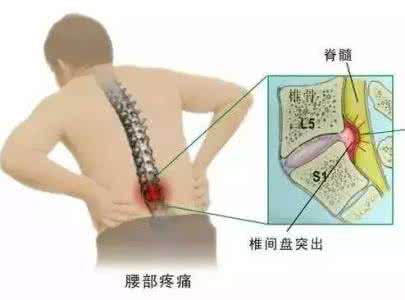 万病一包药的神奇秘方 一个治疗腰椎间盘突出症的神奇秘方，不到几日就痊愈啦