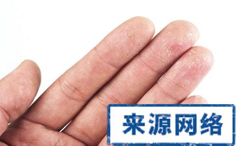 手脱皮是怎么回事 手掌脱皮是什么原因 容易引起手脱皮的几种常见原因