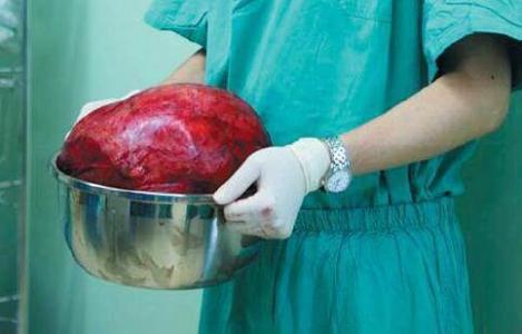 肚脐眼长个小肉疙瘩 男子肚中长出16斤“肉疙瘩” 手术7小时取出