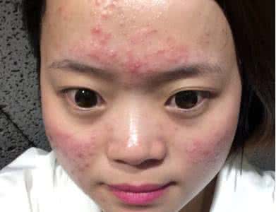 脸上长痘痘怎么办偏方 脸上长痘痘怎么办?