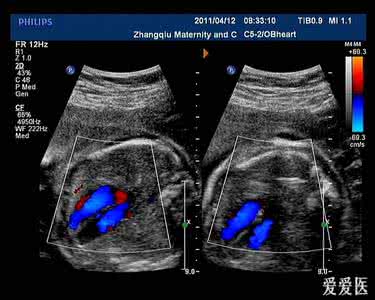超声多普勒血流仪 二维超声结合增强型血流成像技术诊断胎儿心脏畸形的应用观察