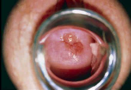 顺产第二胎也要侧切吗 顺产为什么要侧切伤口